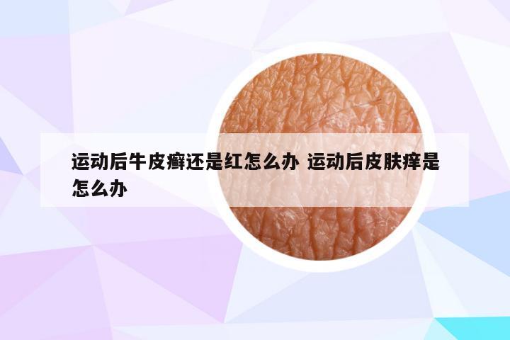 运动后牛皮癣还是红怎么办 运动后皮肤痒是怎么办