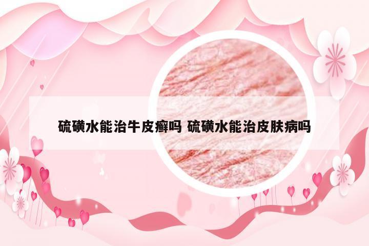 硫磺水能治牛皮癣吗 硫磺水能治皮肤病吗