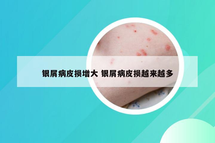 银屑病皮损增大 银屑病皮损越来越多