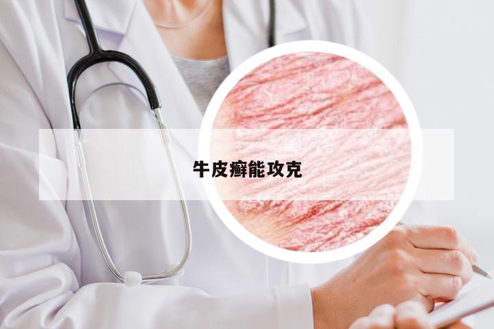 牛皮癣能攻克