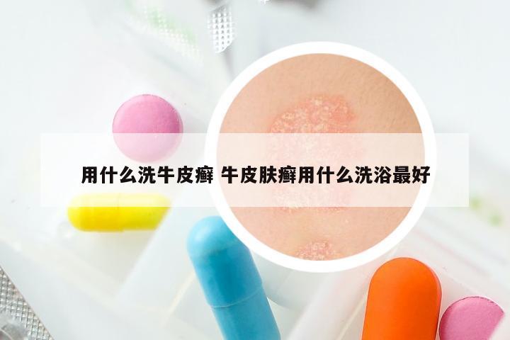 用什么洗牛皮癣 牛皮肤癣用什么洗浴最好