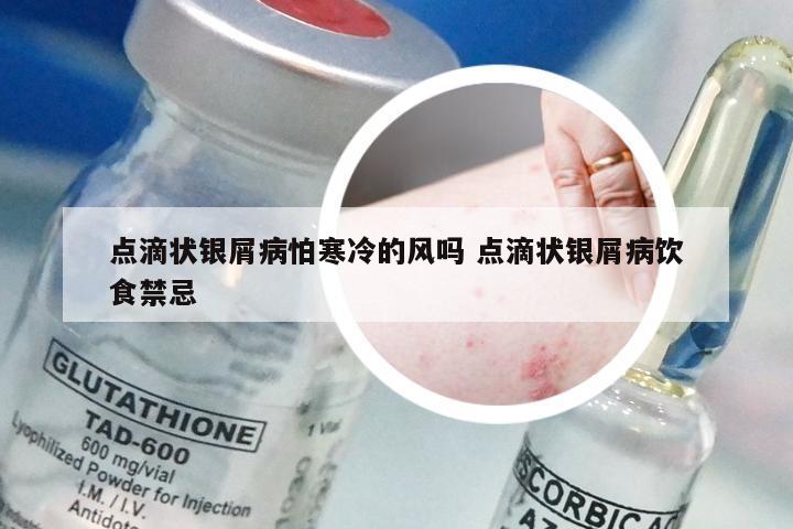 点滴状银屑病怕寒冷的风吗 点滴状银屑病饮食禁忌