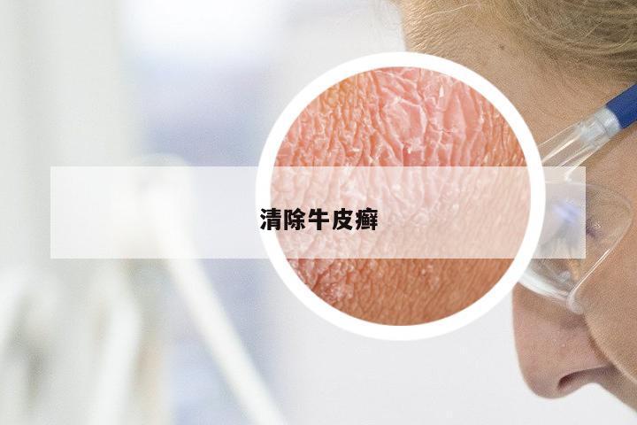 清除牛皮癣