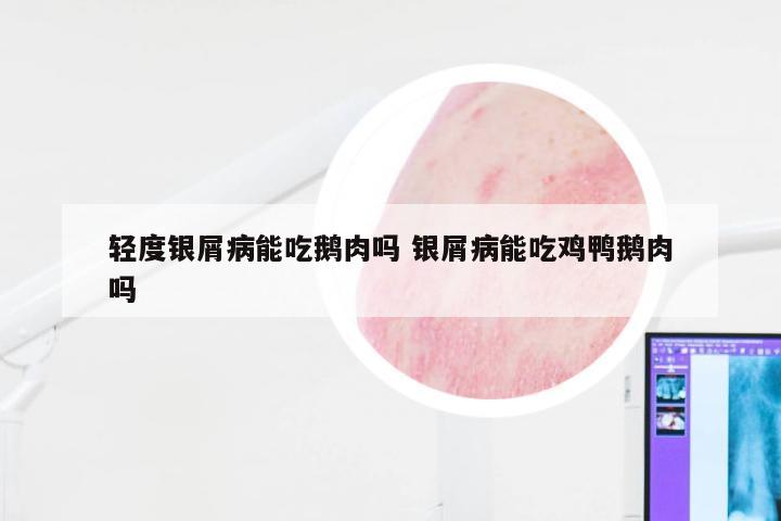 轻度银屑病能吃鹅肉吗 银屑病能吃鸡鸭鹅肉吗