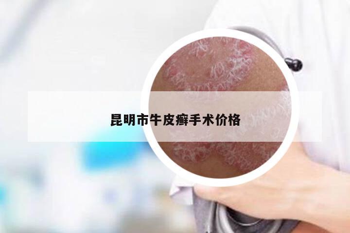 昆明市牛皮癣手术价格