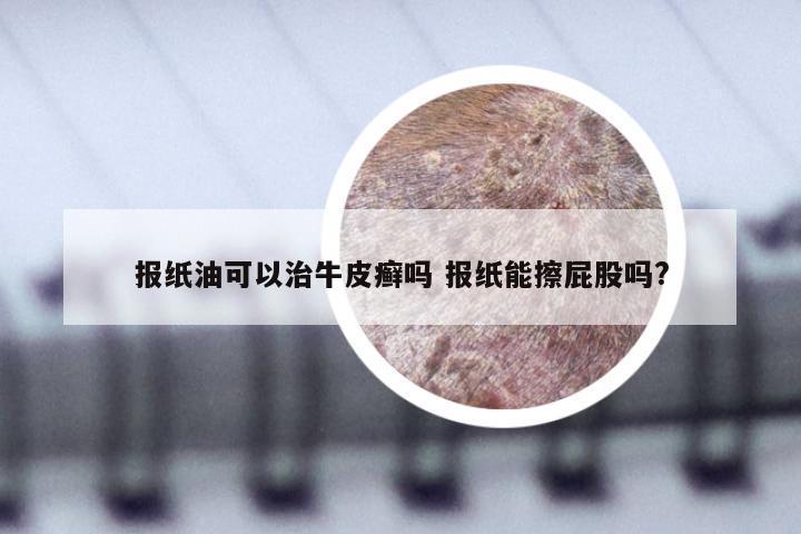 报纸油可以治牛皮癣吗 报纸能擦屁股吗?