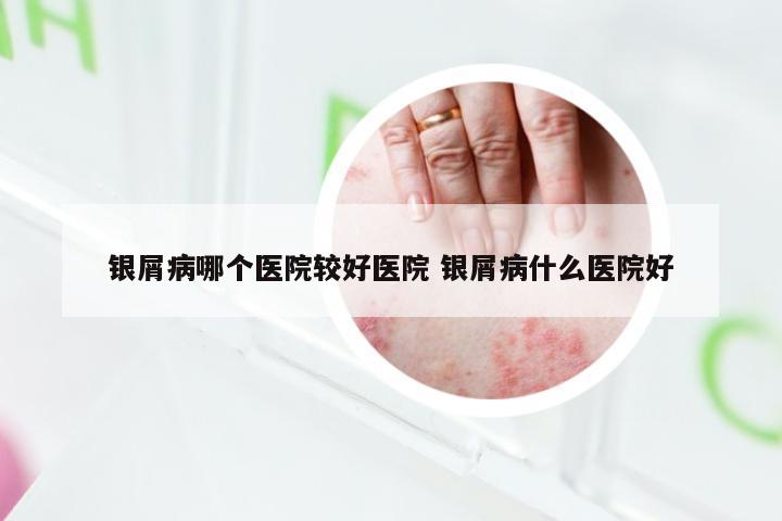 银屑病哪个医院较好医院 银屑病什么医院好