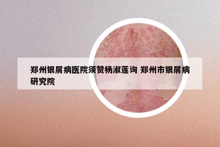 郑州银屑病医院须赞杨淑莲询 郑州市银屑病研究院
