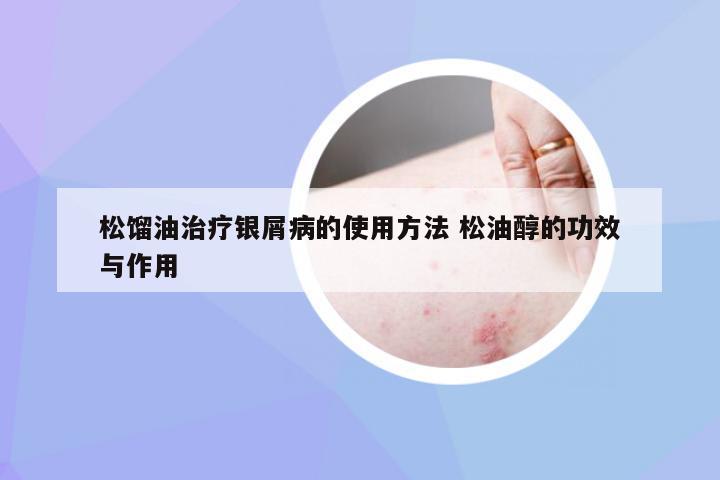 松馏油治疗银屑病的使用方法 松油醇的功效与作用
