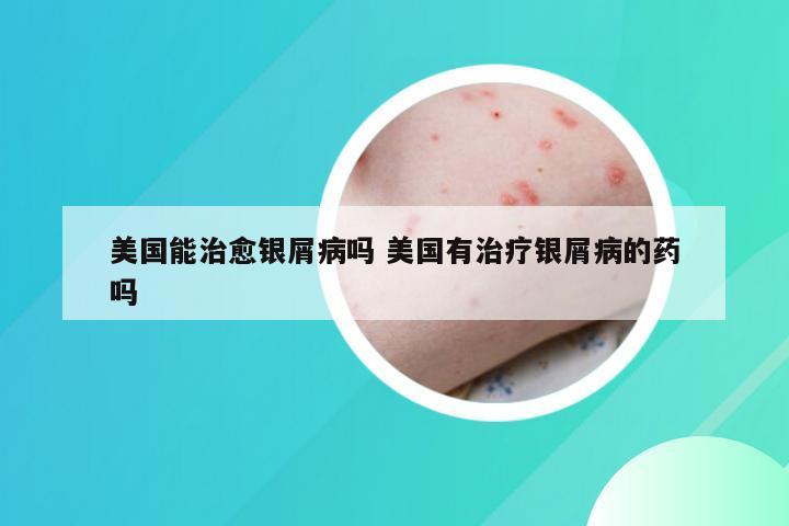 美国能治愈银屑病吗 美国有治疗银屑病的药吗