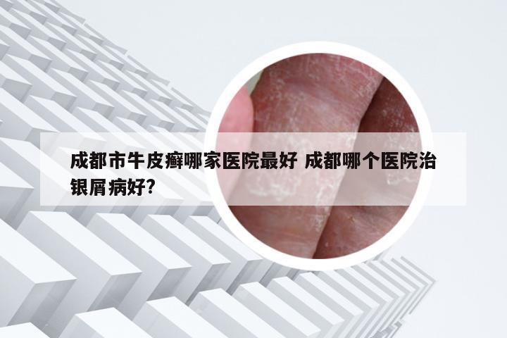 成都市牛皮癣哪家医院最好 成都哪个医院治银屑病好?