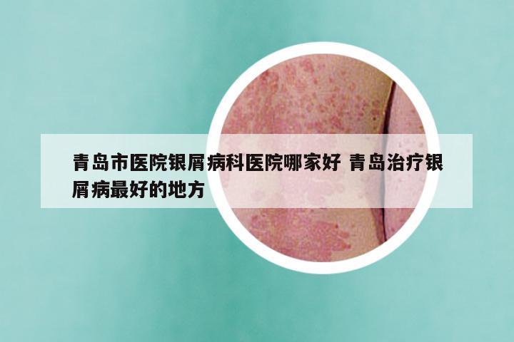 青岛市医院银屑病科医院哪家好 青岛治疗银屑病最好的地方