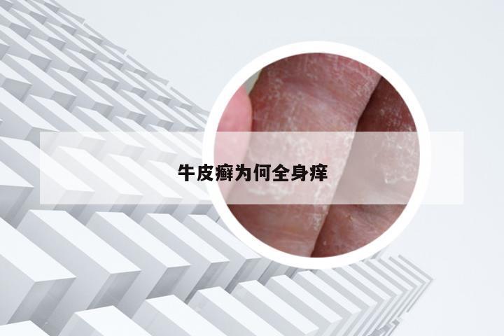 牛皮癣为何全身痒