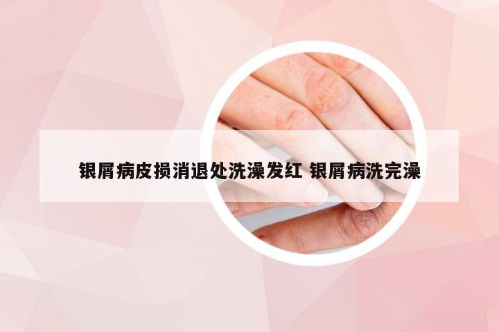 银屑病皮损消退处洗澡发红 银屑病洗完澡