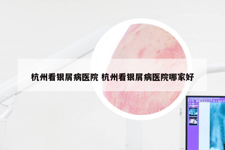 杭州看银屑病医院 杭州看银屑病医院哪家好