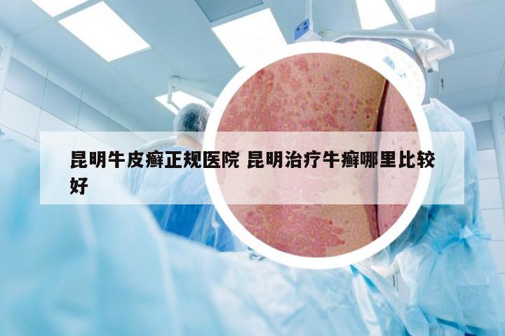 昆明牛皮癣正规医院 昆明治疗牛癣哪里比较好