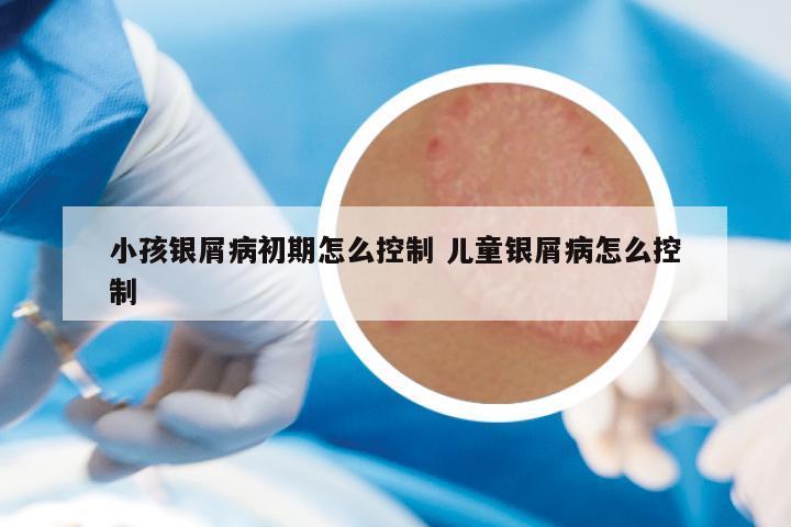 小孩银屑病初期怎么控制 儿童银屑病怎么控制