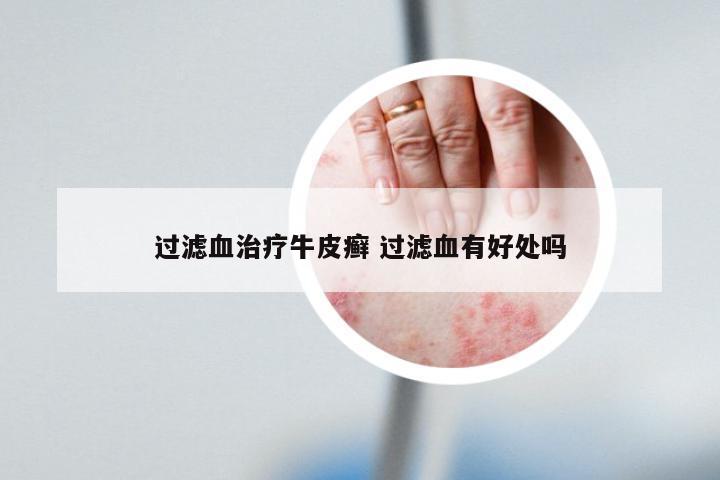 过滤血治疗牛皮癣 过滤血有好处吗