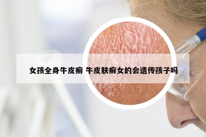 女孩全身牛皮癣 牛皮肤癣女的会遗传孩子吗