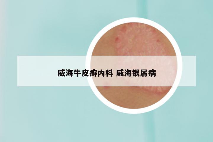 威海牛皮癣内科 威海银屑病