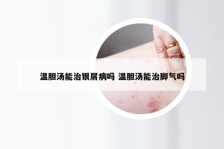 温胆汤能治银屑病吗 温胆汤能治脚气吗