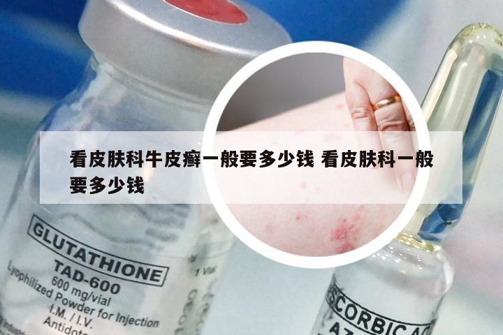 看皮肤科牛皮癣一般要多少钱 看皮肤科一般要多少钱