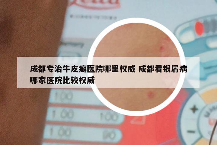 成都专治牛皮癣医院哪里权威 成都看银屑病哪家医院比较权威