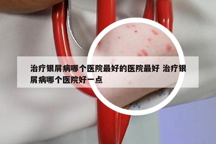 治疗银屑病哪个医院最好的医院最好 治疗银屑病哪个医院好一点