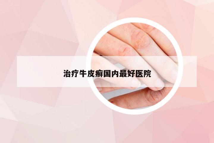 治疗牛皮癣国内最好医院