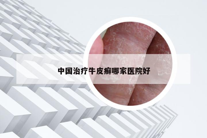 中国治疗牛皮癣哪家医院好