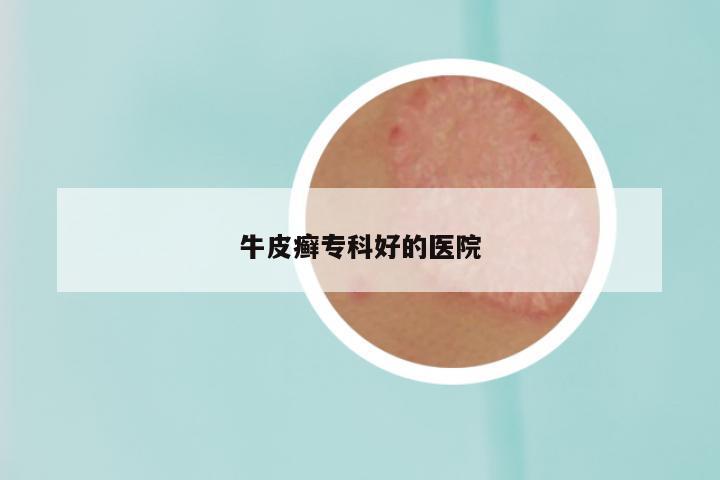 牛皮癣专科好的医院