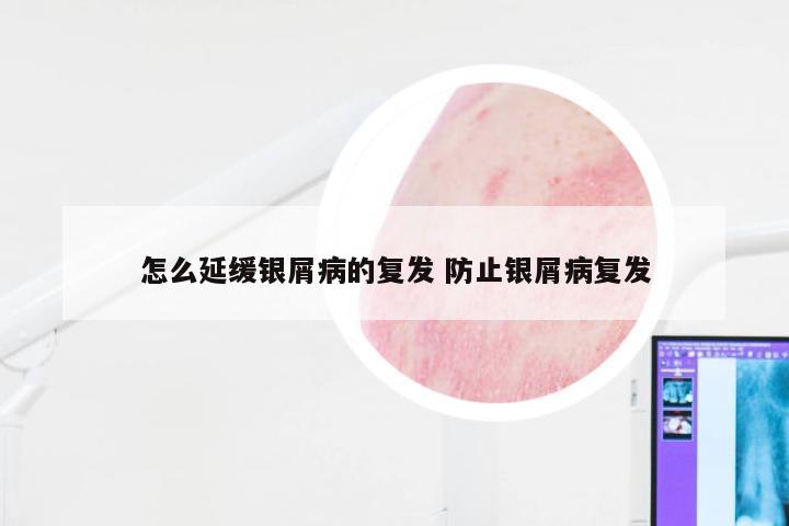 怎么延缓银屑病的复发 防止银屑病复发