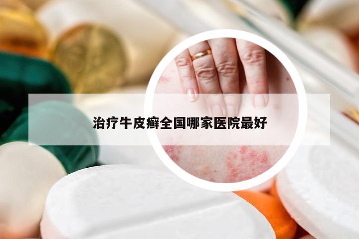治疗牛皮癣全国哪家医院最好