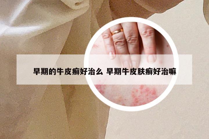早期的牛皮癣好治么 早期牛皮肤癣好治嘛