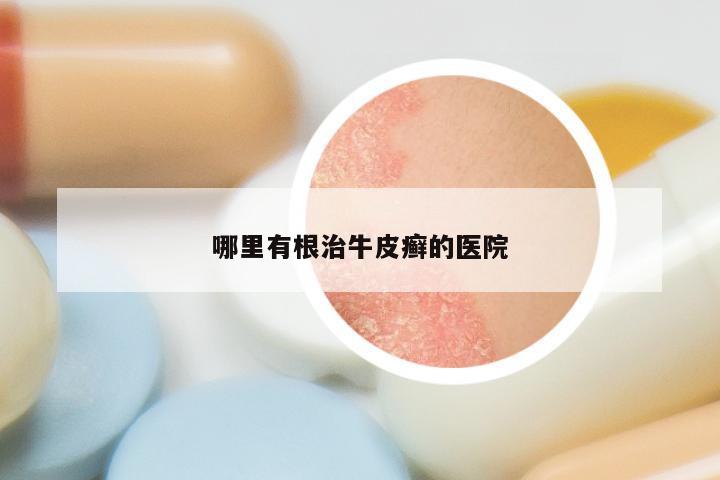 哪里有根治牛皮癣的医院