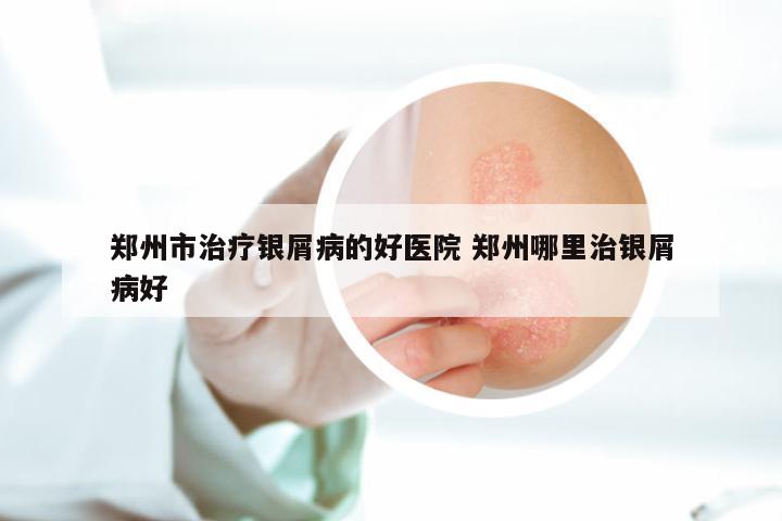 郑州市治疗银屑病的好医院 郑州哪里治银屑病好