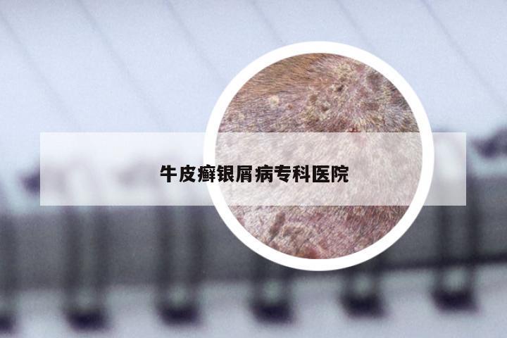 牛皮癣银屑病专科医院