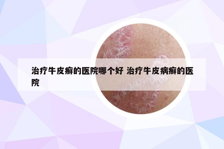 治疗牛皮癣的医院哪个好 治疗牛皮病癣的医院