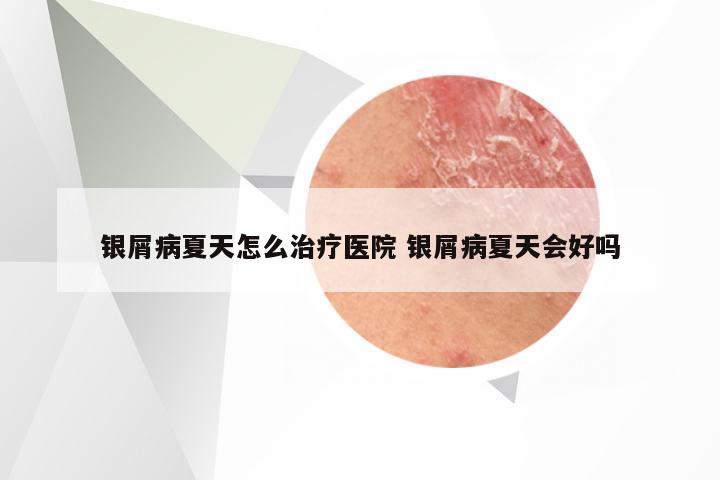 银屑病夏天怎么治疗医院 银屑病夏天会好吗