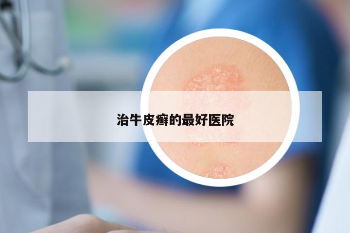 治牛皮癣的最好医院