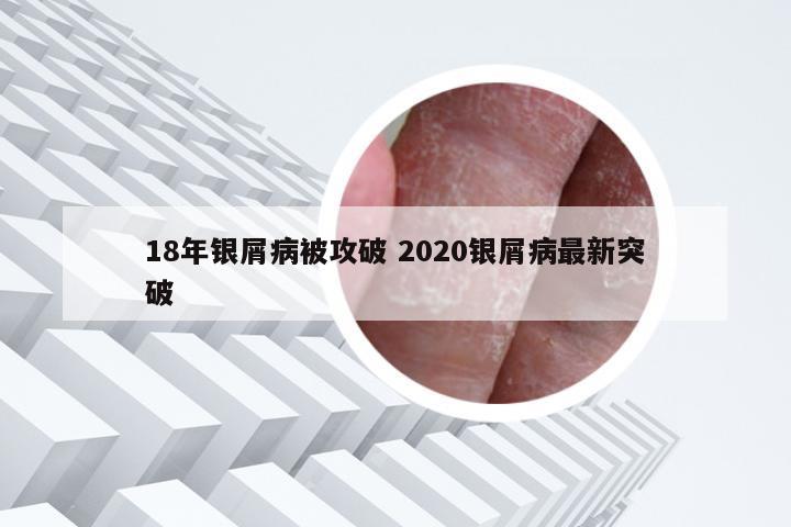 18年银屑病被攻破 2020银屑病最新突破