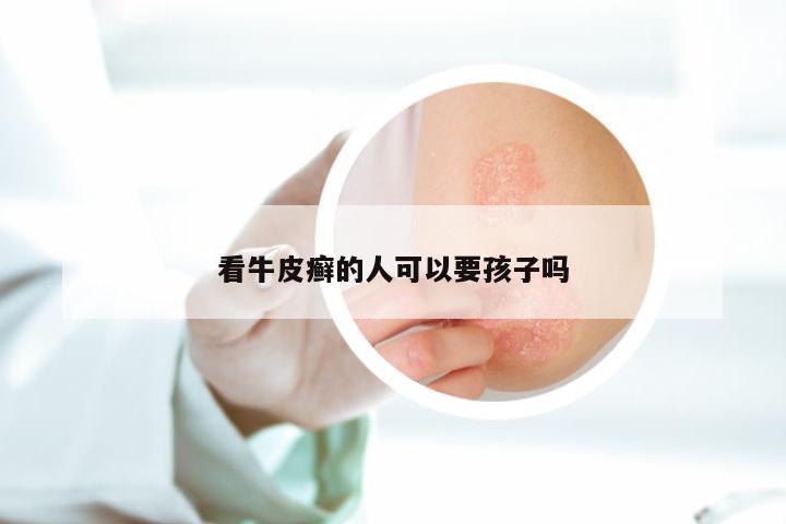 看牛皮癣的人可以要孩子吗