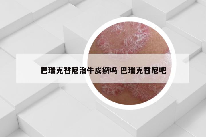 巴瑞克替尼治牛皮癣吗 巴瑞克替尼吧