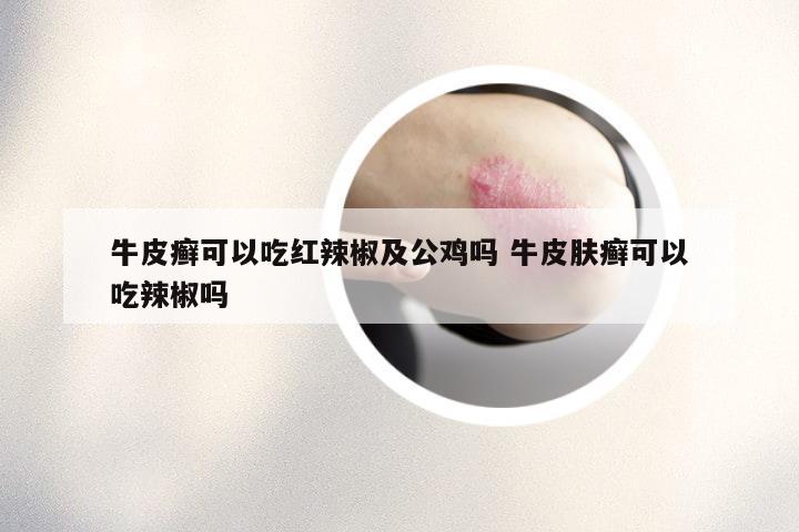 牛皮癣可以吃红辣椒及公鸡吗 牛皮肤癣可以吃辣椒吗