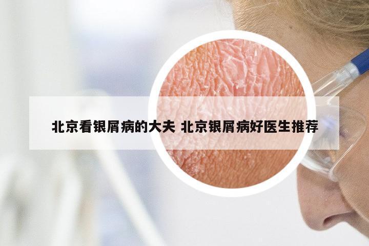 北京看银屑病的大夫 北京银屑病好医生推荐