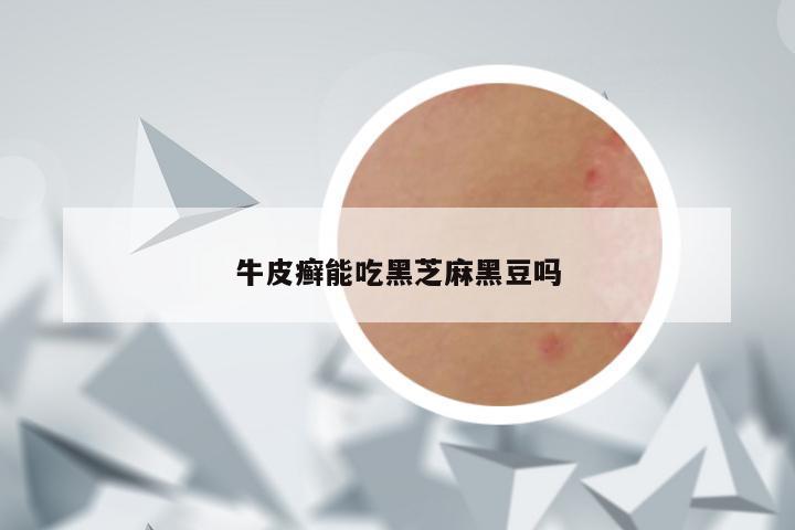 牛皮癣能吃黑芝麻黑豆吗