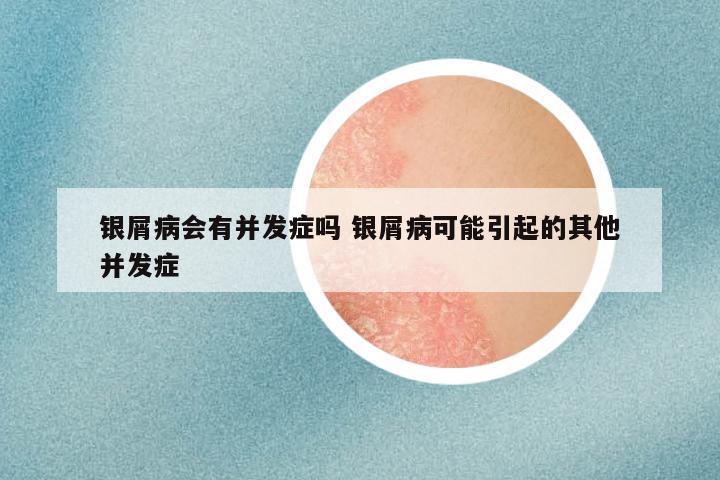 银屑病会有并发症吗 银屑病可能引起的其他并发症