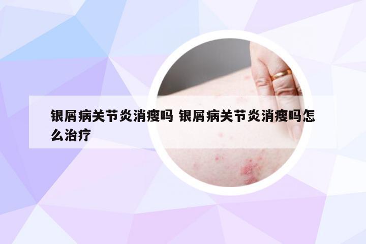 银屑病关节炎消瘦吗 银屑病关节炎消瘦吗怎么治疗