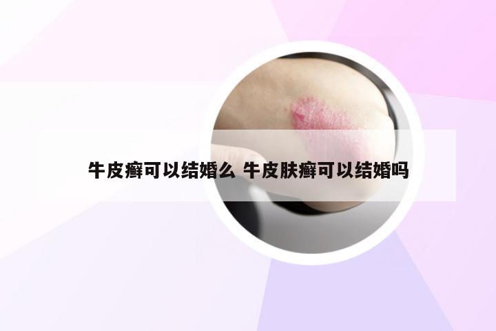 牛皮癣可以结婚么 牛皮肤癣可以结婚吗