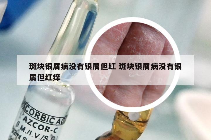 斑块银屑病没有银屑但红 斑块银屑病没有银屑但红痒